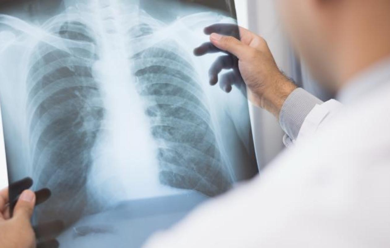 Cancer du poumon : voici le deuxième facteur de risque derrière le tabac