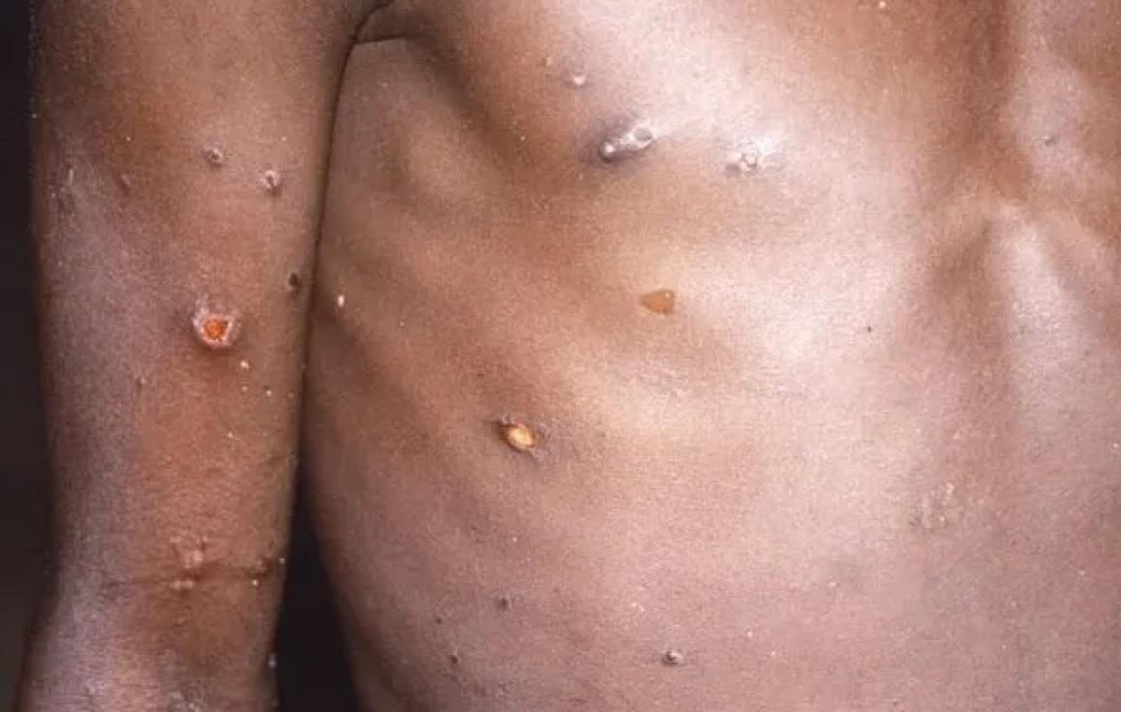 Santé : Un cas de variole du singe détecté à Dakar