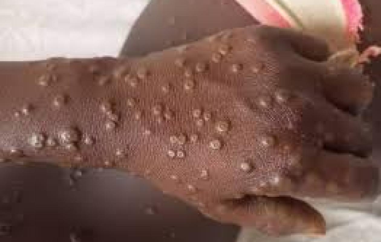 Variole du singe au Sénégal : 25 cas contacts recensés