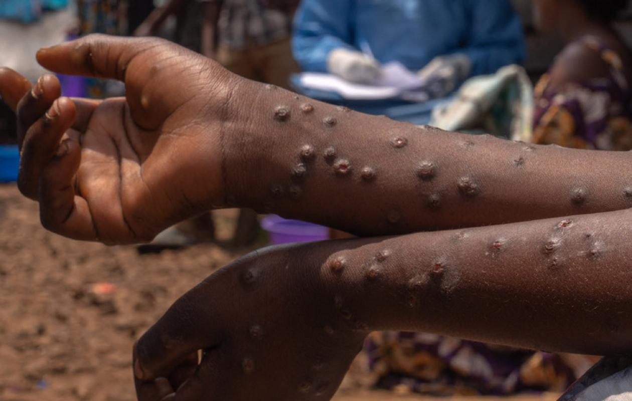 Cas importé de Mpox au Sénégal : Le ministère de la Santé annonce la bonne nouvelle