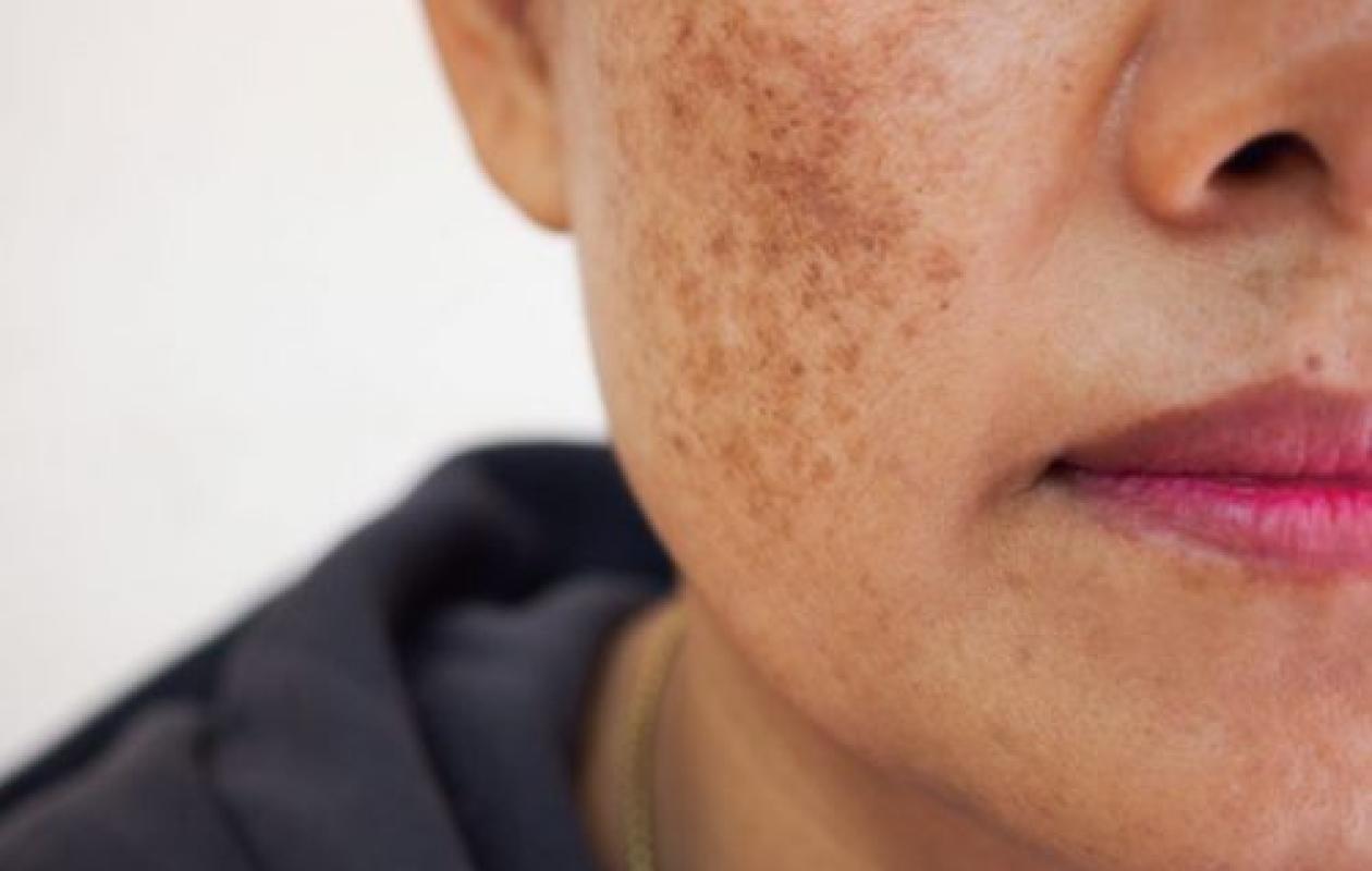 Dépigmentation de la peau-Le paradoxe lumineux : gagner en perdant