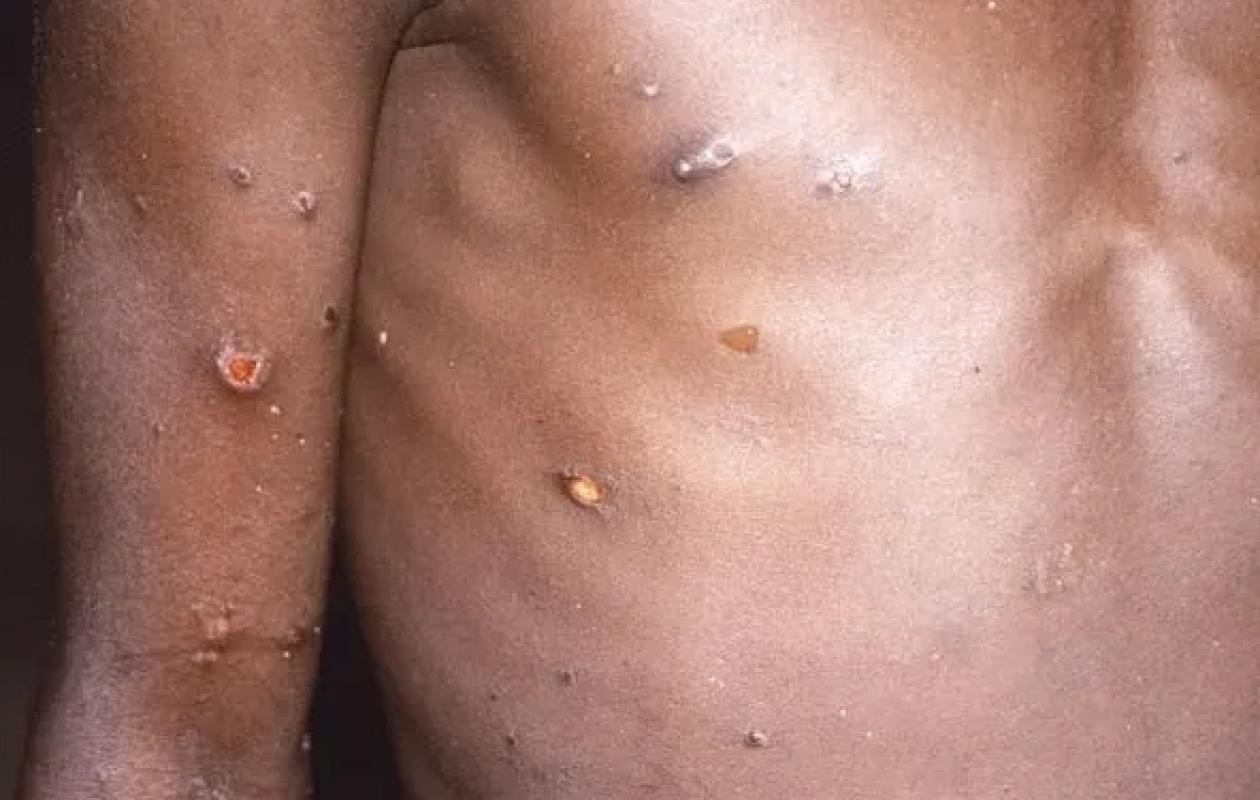 Variole du singe (Mpox) : Un tout nouveau cas détecté au Sénégal !