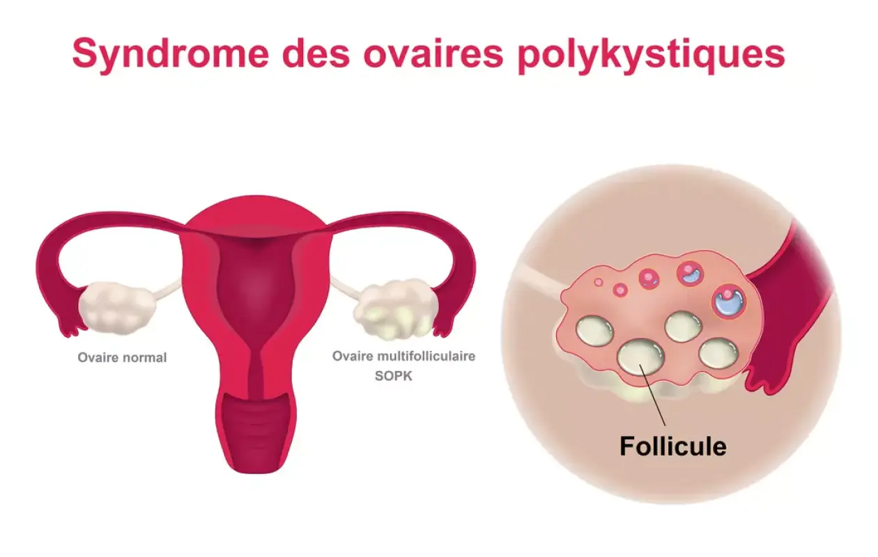 Le syndrome des ovaires polykystiques : Une menace silencieuse pour la santé des jeunes filles au Sénégal
