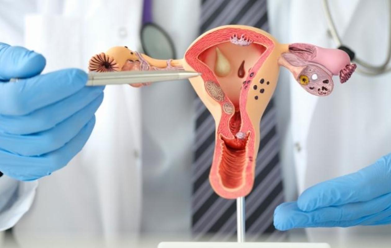 Cancers du col de l’utérus et du sein : 5 cas détectés à Thiès lors d’une séance de dépistage