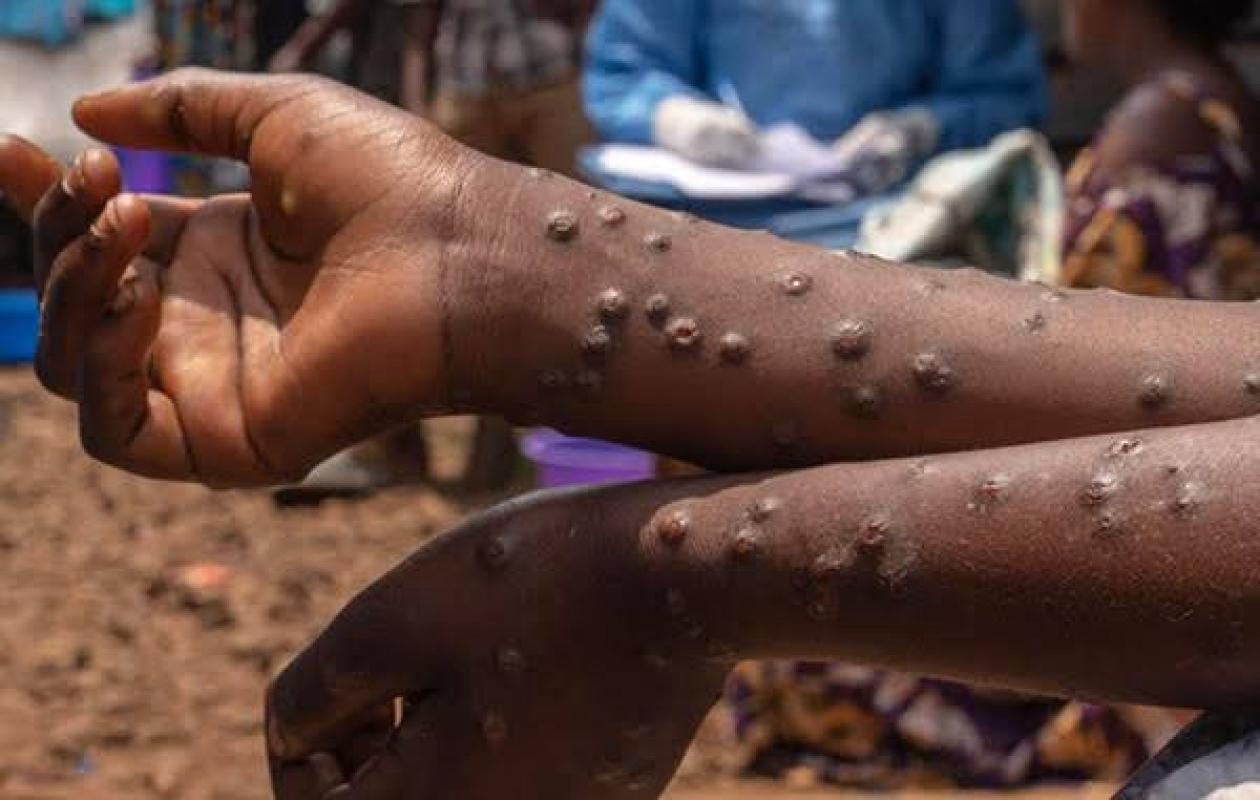 Épidémie : Progression contenue de la Fièvre de la Vallée du Rift et du Mpox