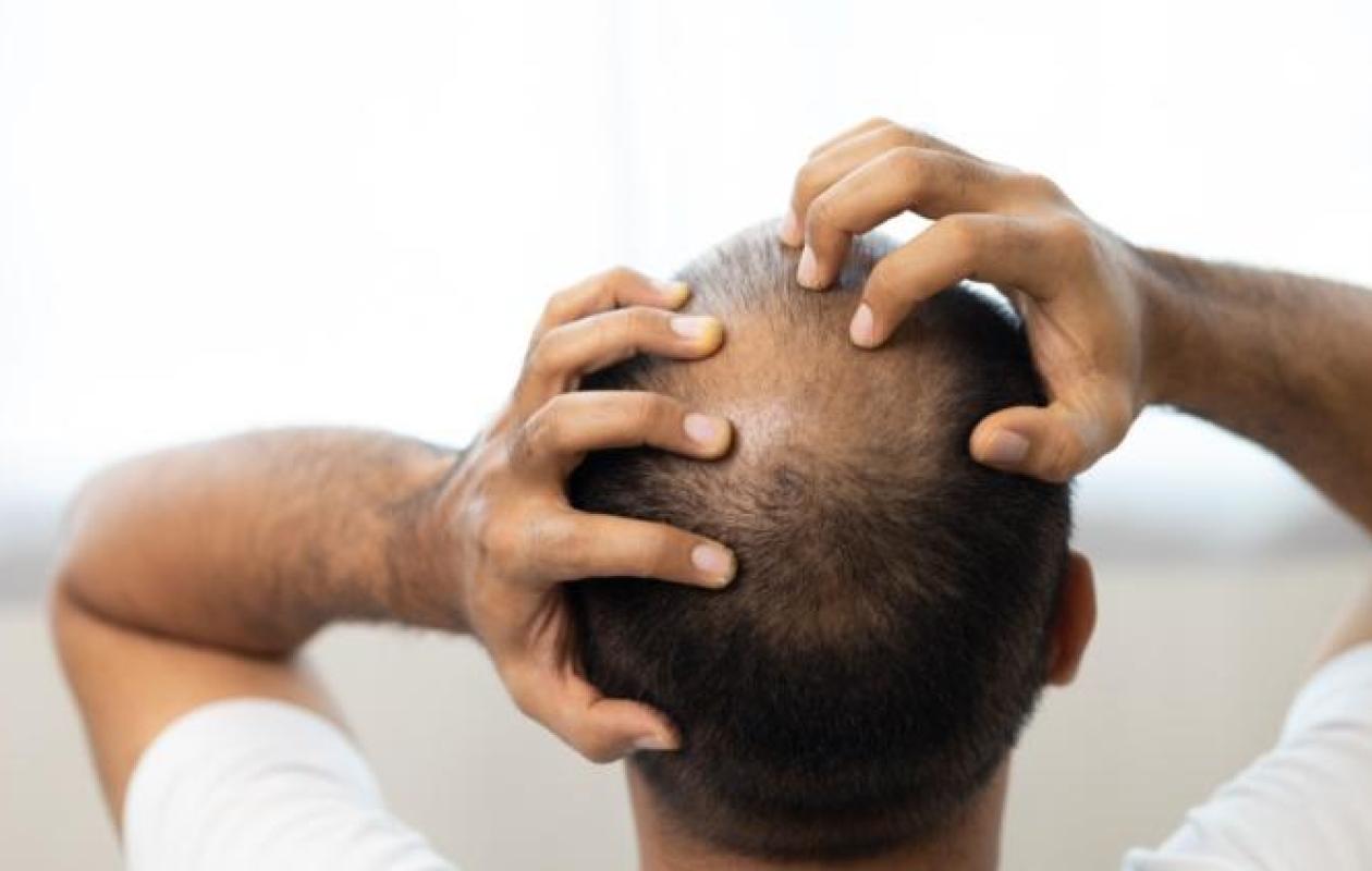 Sérum qui fait repousser les cheveux en 20 jours : tout savoir sur ce traitement contre la calvitie