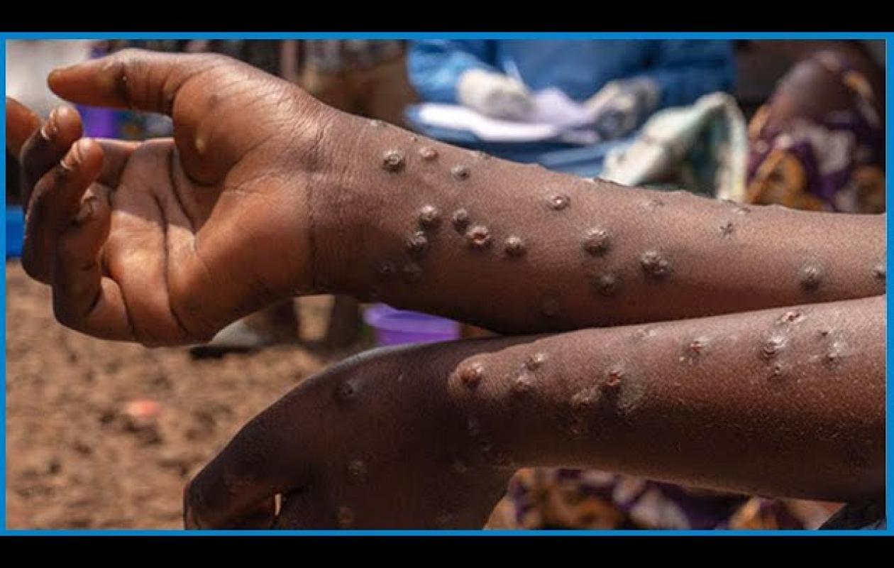 Fièvre de la vallée du Rift (FVR) et de Mpox au Sénégal : Le point sur l'évolution des épidémies