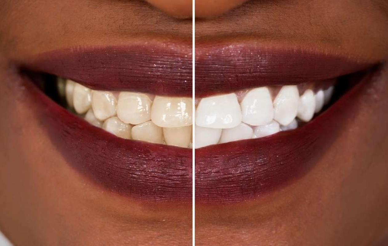 Blanchiment dentaire : L’Ordre des dentistes sonne « l’alerte rouge » face aux charlatans