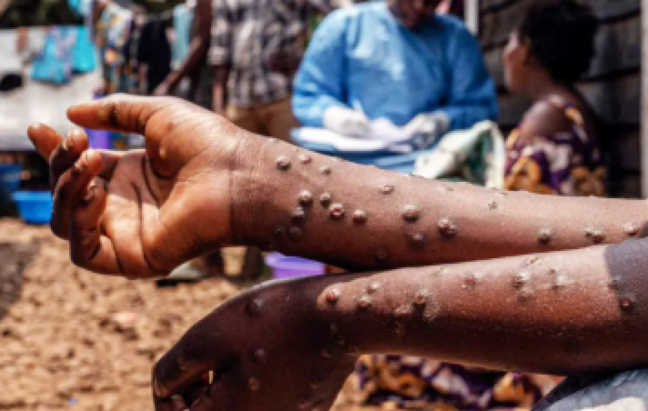 Madagascar : premier décès lié au Mpox