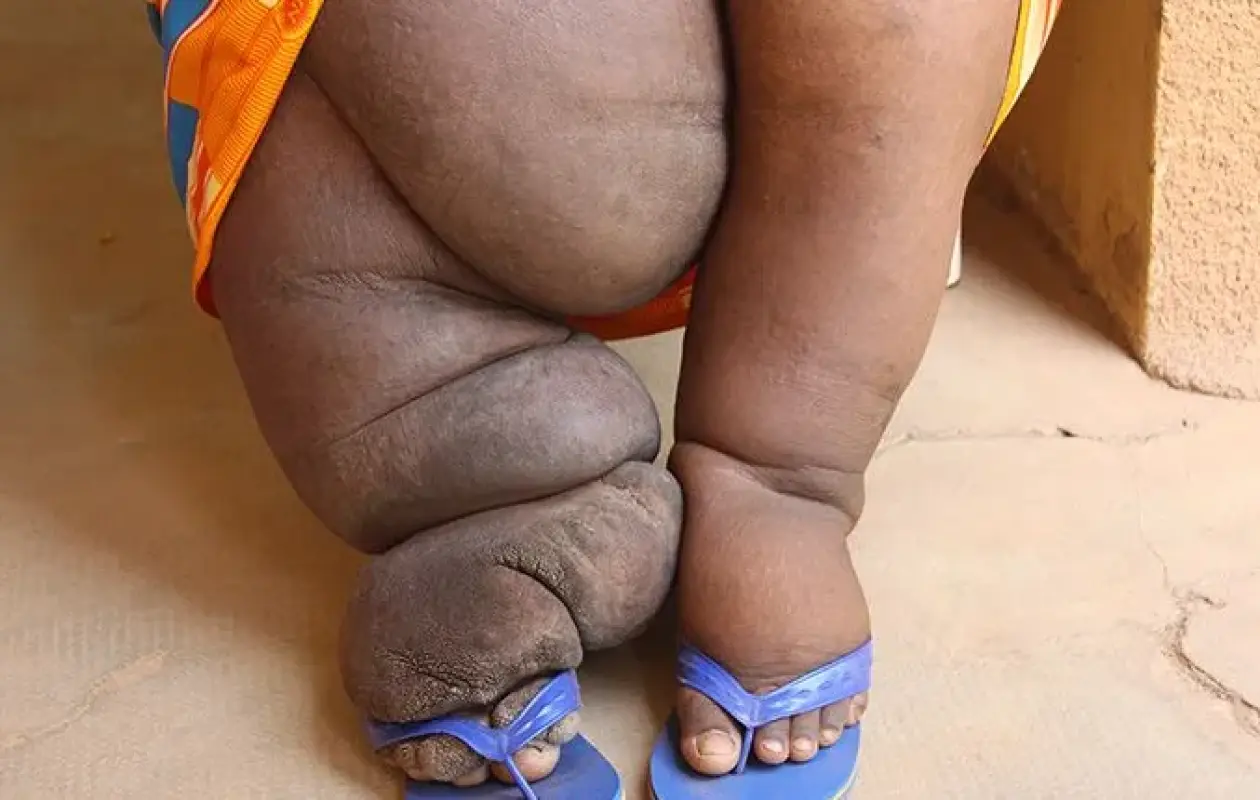 [Focus] Lymphœdème : Le calvaire des "malades de l'ombre" entre douleur et stigmatisation