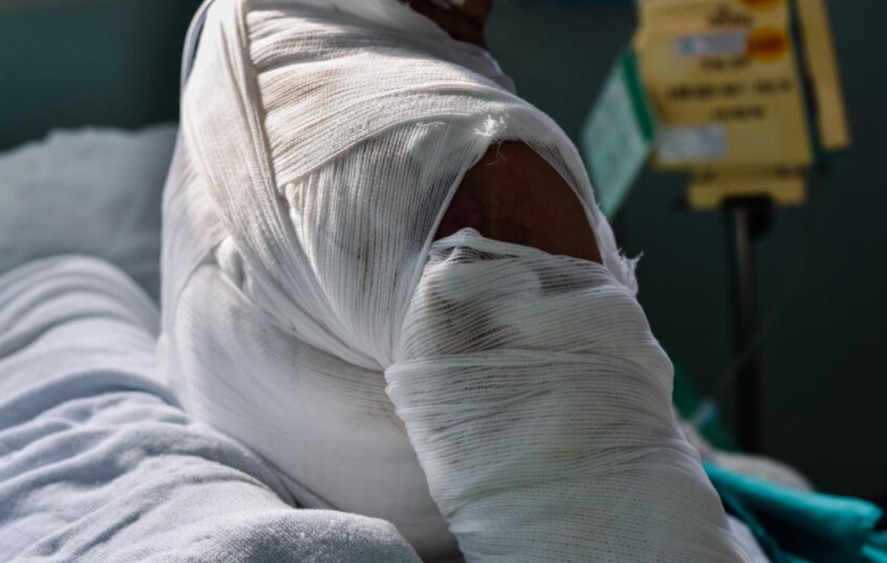 Richard-Toll : une jeune femme grièvement brûlée, sa belle-sœur en garde à vue