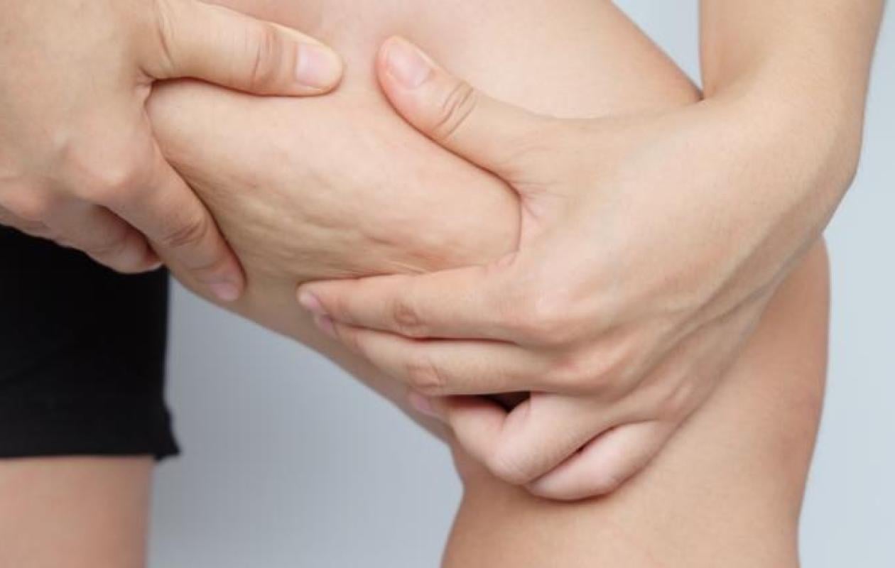 Lipœdème : quelle est cette maladie qui toucherait 1 femme sur 10 ?