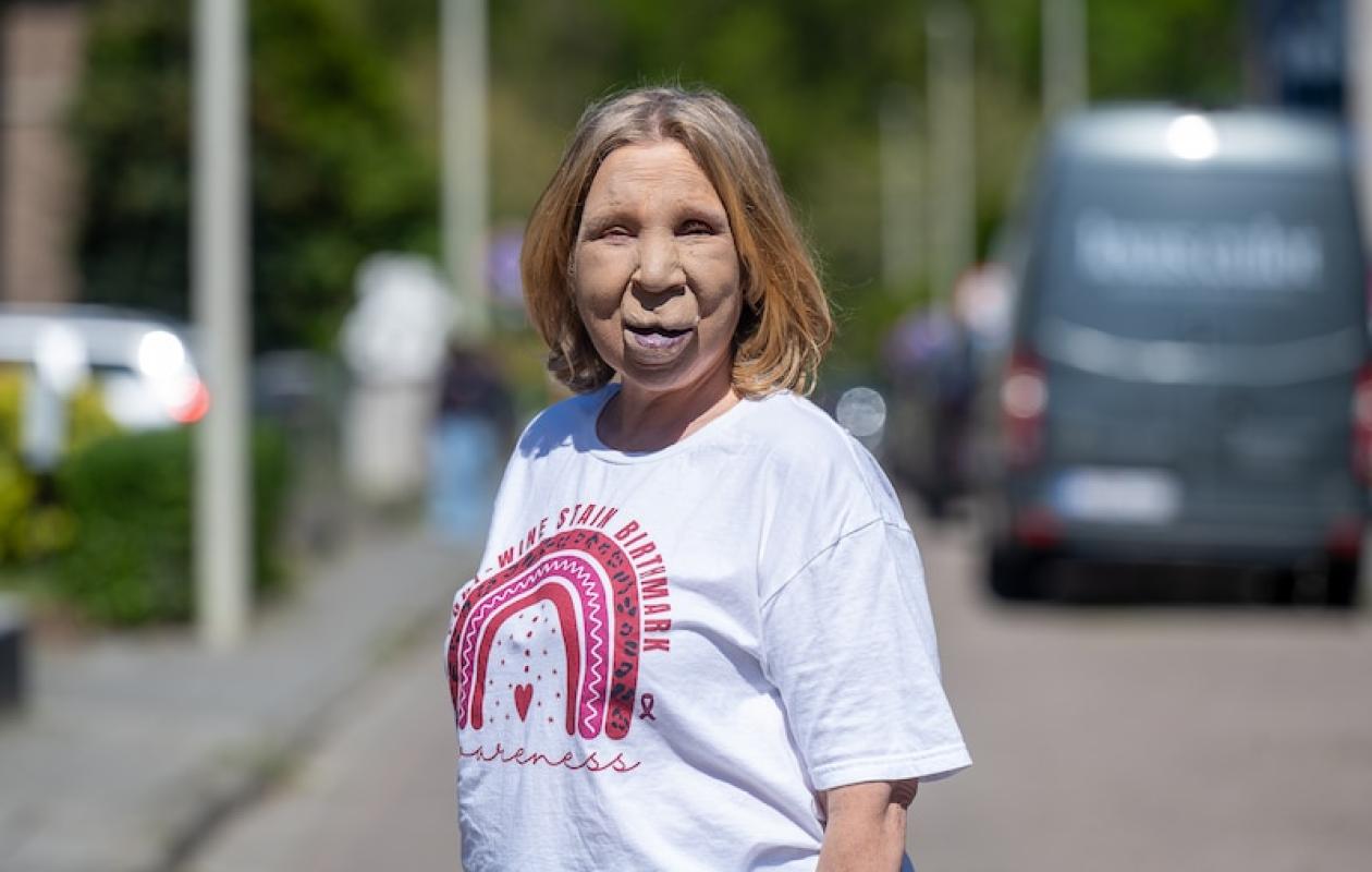 Nancy, 56 ans, souffre d’une maladie rare: “J’en ai marre qu’on me dévisage”
