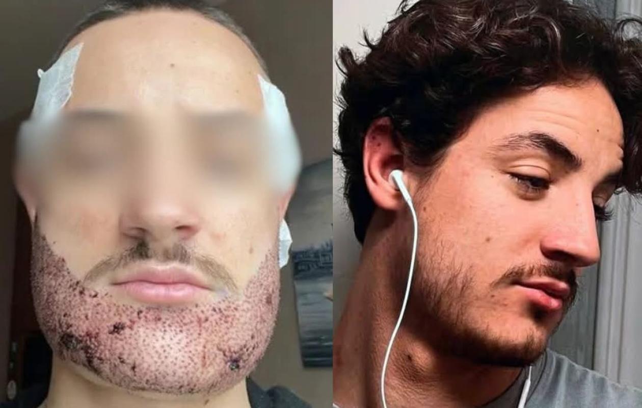 Turquie : un étudiant français se suicide après une greffe de barbe ratée