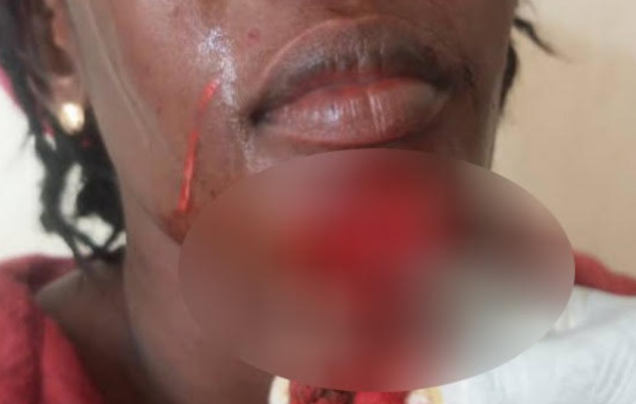 Méouane : Une femme sauvagement agressée et défigurée par sa coépouse et sa belle-sœur